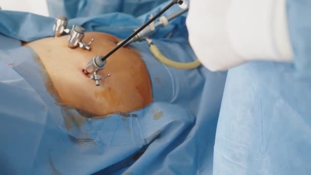 Instruments de chirurgie laparoscopique au travail. Processus d'opération chirurgicale utilisant un équipement laparoscopique. Salle d'opération avec équipement chirurgical. — Video