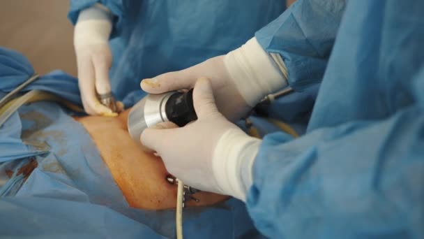 Nástroje pro laparoskopickou operaci v práci. Chirurgický zákrok pomocí laparoskopického vybavení. Operační sál s chirurgickým vybavením. — Stock video