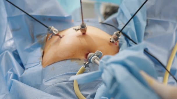 복강경 장비를 사용하는 수술. 수술실에서 복강경 수술을 하는 외과 의사들 입니다. 최소 침습적 인 수술이야. 닫아 — 비디오