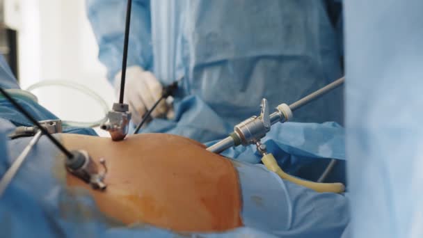 Los cirujanos que hacen cirugía laparoscópica en el quirófano. Cirugía mínimamente invasiva. Los cirujanos trabajan en equipo durante la operación abdominal laparoscópica. Operación con equipo laparoscópico. — Vídeo de stock