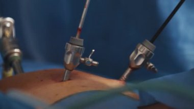 Endoskopi. Yakın plan. Cerrahlar endoskopik ekipman ve aletlerin yardımıyla şişman bir adamın veya hamile bir kadının ameliyatını yaparlar. Ameliyathanede, doktor laparoskopi yapıyor..