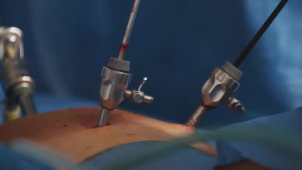 Endoscopia. Primer plano. Los cirujanos manos con la ayuda de equipos e instrumentos endoscópicos realizan la cirugía de un hombre gordo o una mujer embarazada. En el quirófano, el médico hace una laparoscopia. — Vídeos de Stock