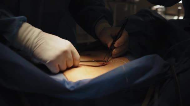 Sluiten van een chirurg hand hechten van een wond na een succesvolle operatie.Professionele chirurg gewonde na succesvolle chirurgie. — Stockvideo