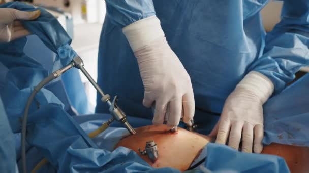 Proceso de operación quirúrgica con equipo laparoscópico. Instrumentos para cirugía laparoscópica en el trabajo. Sala de operaciones con equipo quirúrgico. Extirpación del tumor — Vídeo de stock