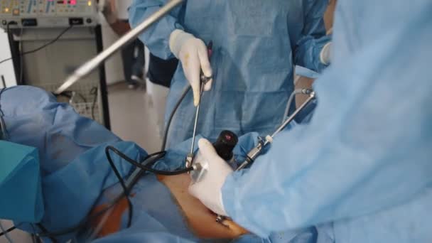 Equipo de cirujanos durante la operación de proceso extirpación del útero con instrumentos de laparoscopia quirúrgica. Ginecología. Cirugía endoscópica para extirpar el útero — Vídeos de Stock