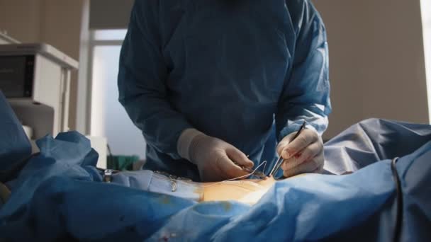Μια ομάδα χειρουργών ράβει το σώμα των ασθενών. Βελονάκι και χειρουργική κλωστή στα χέρια του χειρουργού. Γιατροί με αποστειρωμένα γάντια, χειρουργικές στολές και χειρουργικές μάσκες. Ράβει το δέρμα — Αρχείο Βίντεο