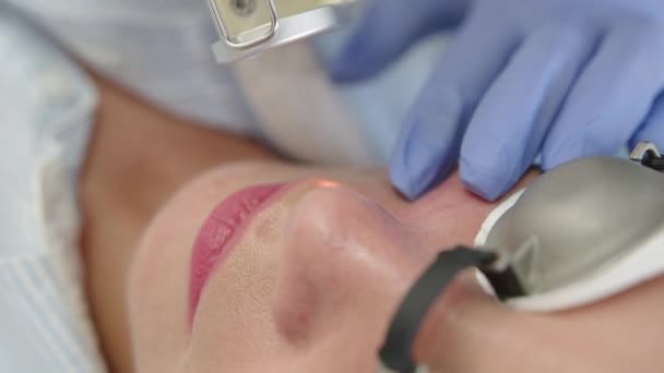 A girl gets a carbon facial peeling in a close-up beauty salon. Laser pulses cleanse the skin of the face. Hardware cosmetology. The process of photothermolysis, warming the skin. Scar removal — Video