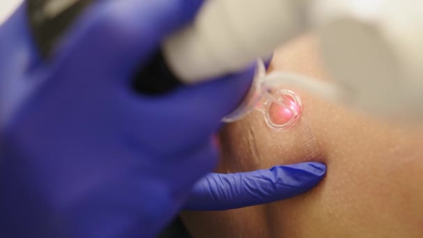 Skin Procedure. Closeup Of Beautician Doing Skin Dermabrasion Using Professional Apparatus. Beautiful Girl Receiving Skin Rejuvenation And Resurfacing In Beauty Salon. Laser Therapy. High Resolution — Stock Video