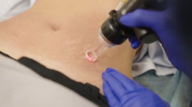 Lazer estetik cerrahi ve cilt dermatolojisinde yeniden yüzeye çıkıyor. Cilt bakımı kliniğinde lazer olması, cilt kırışıklıkları, yara izleri ve güneş hasarları için yeniden yüzeye çıkma tekniği..
