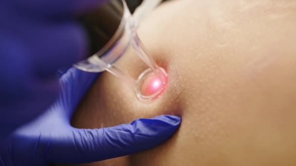 Co2 laser resurfacing treatment for belly. Abdominal rejuvenation. Hardware cosmetology. Having a laser in a skincare clinic, a resurfacing technique for wrinkles, scars and solar damage to the skin. — Stock Video