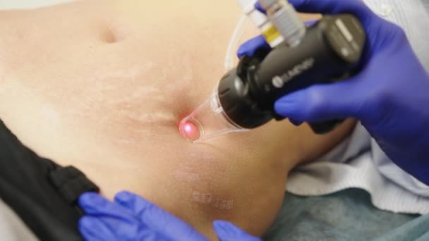Laserowy zabieg kosmetyczny i nawierzchnia skóry w dermatologii. Posiadanie lasera w klinice pielęgnacji skóry, technika ponownego naświetlania zmarszczek, blizn i uszkodzeń skóry spowodowanych działaniem promieniowania słonecznego. — Wideo stockowe