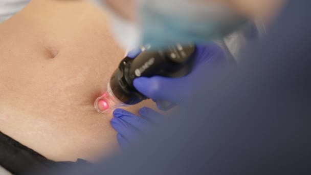 Remoção de cicatriz ou tratamento de depilação na pele usando a técnica de CO2. Ter um laser em uma clínica de cuidados com a pele, uma técnica de resurfacing para rugas, cicatrizes e danos solares à pele. — Vídeo de Stock
