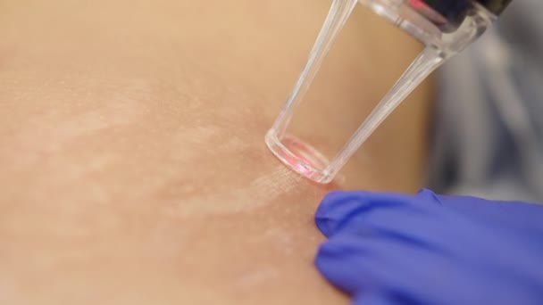 Laserová kosmetická chirurgie a znovuobjevení kůže v dermatologii. Kosmetický laserový technik provádějící znovuobjevení pokožky na lékařské lázeňské a kosmetické klinice. Laserové pulsy čistí pokožku. — Stock video