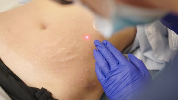 Frau erhält eine Laser-Hautbehandlung oder Laser-Wiederbelebung von Narben in einer Hautpflege-Kosmetikklinik. Wiederauftauchende Technik für Falten, Narben und Sonnenschäden der Haut. — Stockvideo