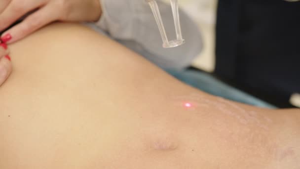 Hautverfahren. Nahaufnahme einer Kosmetikerin, die Hautdermabrasion mit professionellen Geräten durchführt. Schöne Mädchen erhalten Hautverjüngung und Wiederbelebung im Schönheitssalon. Lasertherapie. Hohe Auflösung — Stockvideo