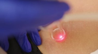 Lazer estetik cerrahi ve cilt dermatolojisinde yeniden yüzeye çıkıyor. Cilt bakımı kliniğinde lazer olması, cilt kırışıklıkları, yara izleri ve güneş hasarları için yeniden yüzeye çıkma tekniği..