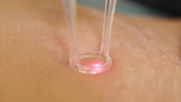 Tratamento de resurfacing a laser de Co2 para barriga. Rejuvenescimento abdominal. Cosmetologia de hardware. Ter um laser em uma clínica de cuidados com a pele, uma técnica de resurfacing para rugas, cicatrizes e danos solares à pele. — Vídeo de Stock