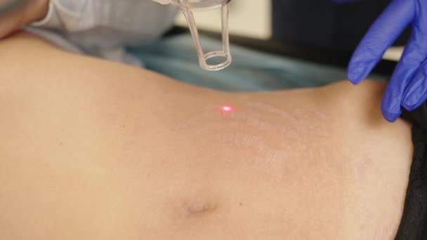 激光整容手术和皮肤科的皮肤再造。在皮肤科诊所使用激光，这是一种用于治疗皱纹、疤痕和皮肤太阳辐射损伤的修复技术. — 图库视频影像