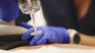 Karbondioksit tekniğini kullanarak ciltteki yara izini almak ya da tüy aldırmak. Cilt bakımı kliniğinde lazer olması, cilt kırışıklıkları, yara izleri ve güneş hasarları için yeniden yüzeye çıkma tekniği..