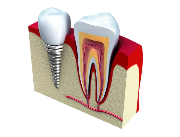 Anatomie des dents saines et implant dentaire dans l'os de la mâchoire . — Photo