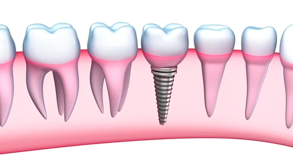 Fogászati implantátum részletes nézet. 3D-s illusztráció — Stock Fotó