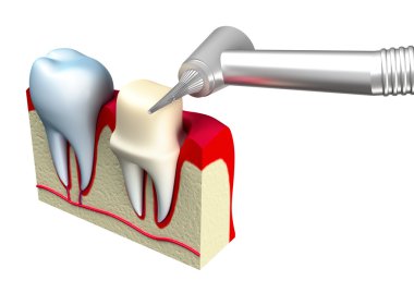 Protez diş taç hazırlık. 3D görüntü