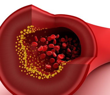 Closeup view of cholesterol plaque in blood vessel clipart