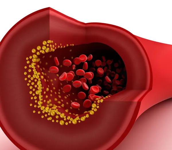 Closeup view of cholesterol plaque in blood vessel — Stock Photo, Image