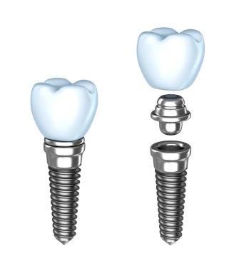 Diş implantı. ? ssembled ve demonte. Beyaz izole.