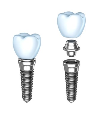 Tooth implant. Аssembled and disassembled. Isolated on white. clipart