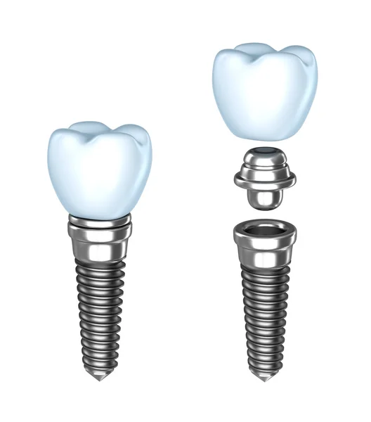 Diş implantı. ? ssembled ve demonte. Beyaz izole.