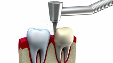 Diş crown yükleme işlemi