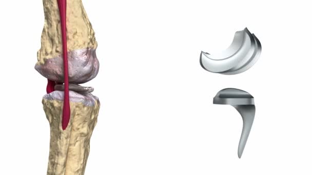 Knee and titanium hinge joint process — Stock Video