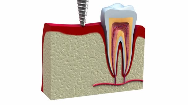 Sağlıklı dişler ve diş implant çene kemiği anatomisi. — Stok video