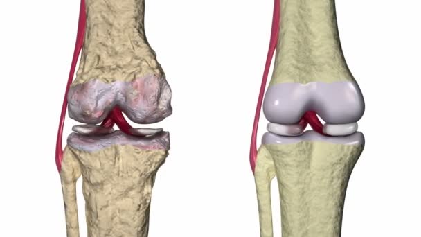 Osteoartritis: articulación de rodilla con ligamentos y cartílagos — Vídeo de stock