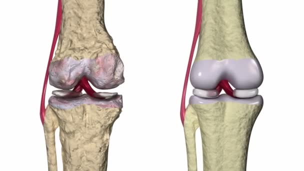 Osteoartritis: articulación de rodilla con ligamentos y cartílagos — Vídeos de Stock