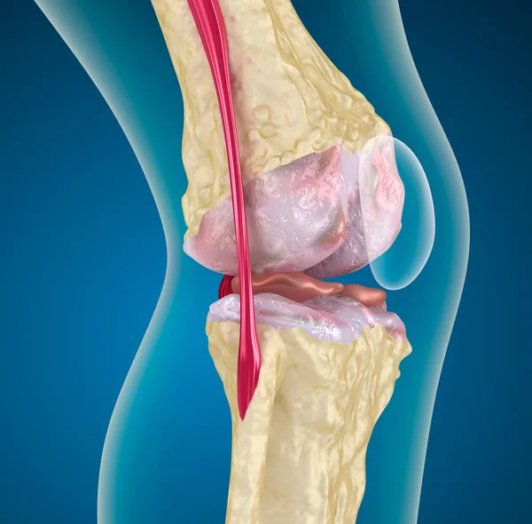 Osteoporosis de la articulación de la rodilla — Foto de Stock