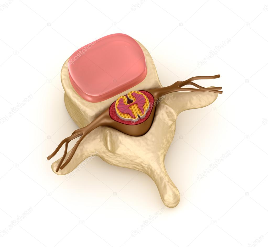 Spinal segment with a disk