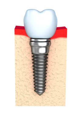 Dental implant çene kemiği içinde