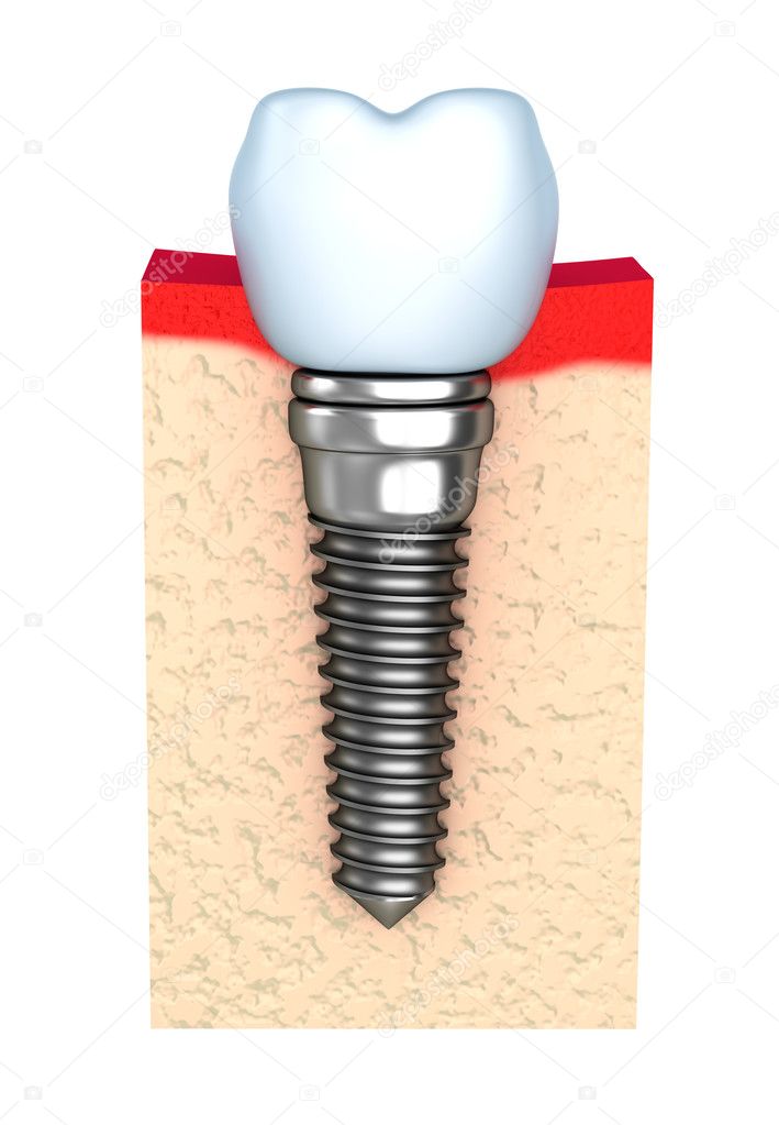 Dental implant in jaw bone
