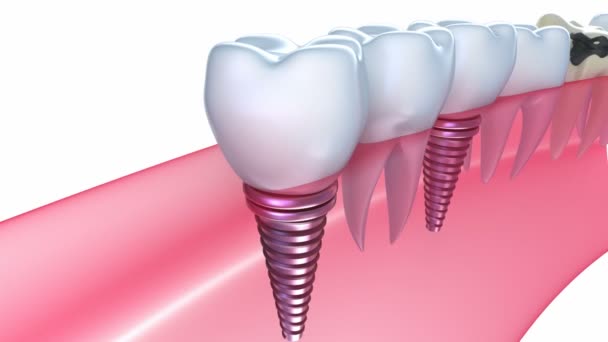 Implantes dentales en la encía — Vídeos de Stock