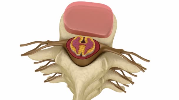 Intervertebral disk Valv — Stok video