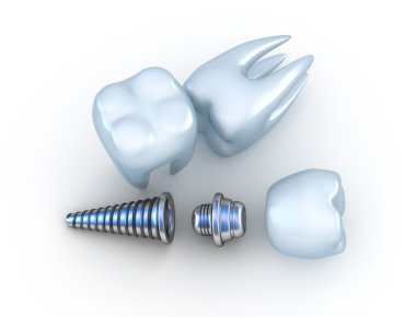 implant diş ve diş, üzerinde beyaz izole