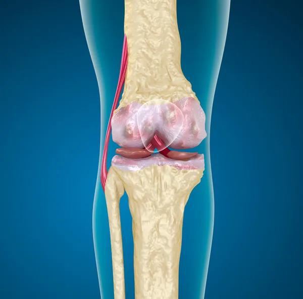 Osteoporóza kolenního kloubu. — Stock fotografie