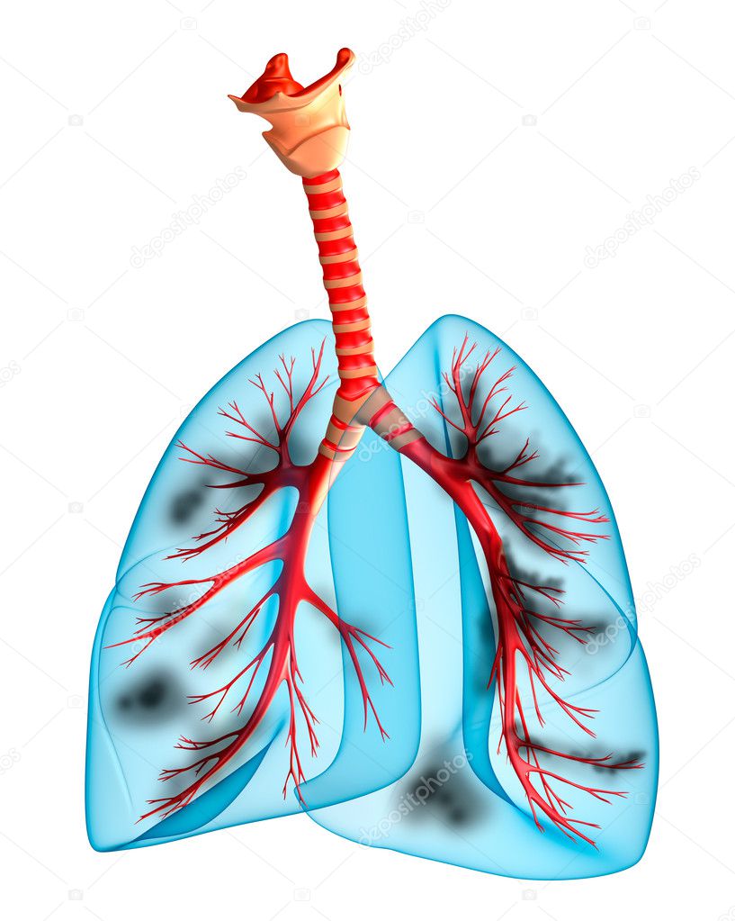 Diseased lungs