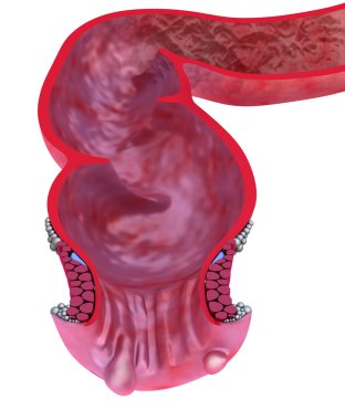 hemoroid: anal hastalıklar