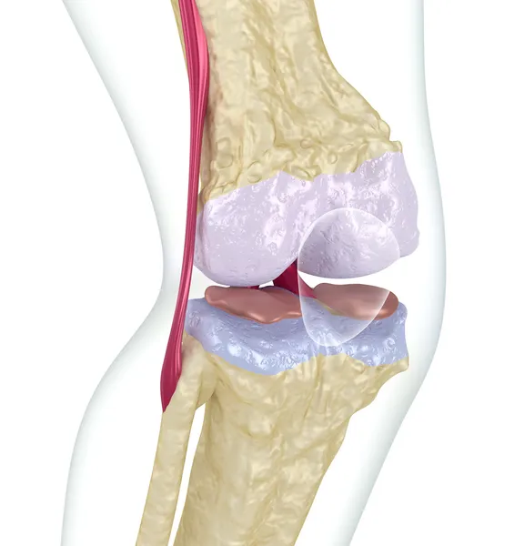 Остеопороз коленного сустава . — стоковое фото
