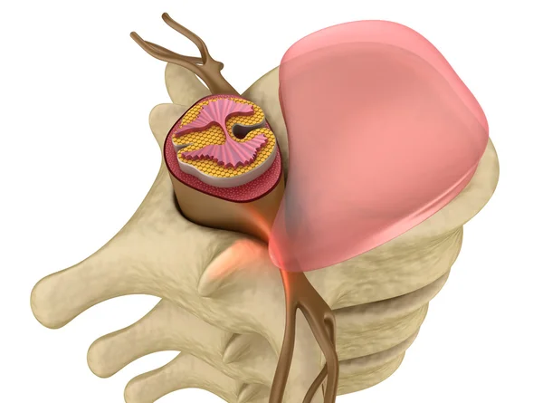 Prolapse of intervertebral disc closeup — Stock Image Prolapse of intervertebral disc closeup Stock Picture
