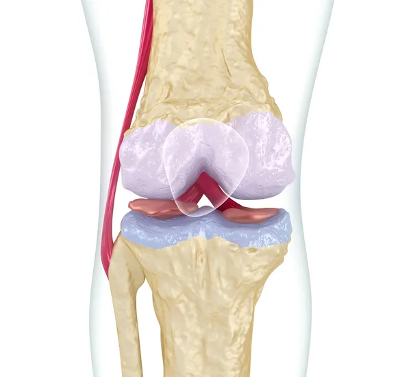 Osteoporos i knäleden. — Stockfoto