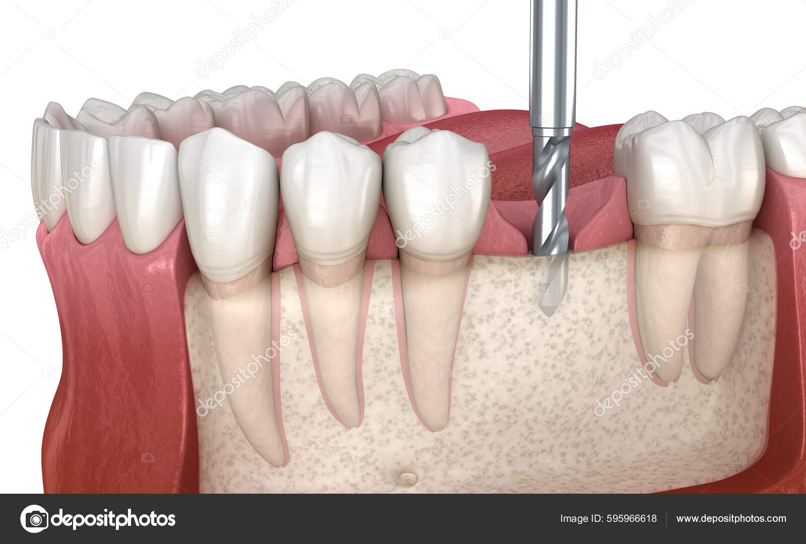 Drilling Bone Dental Implant Placement Medically Accurate Illustration
